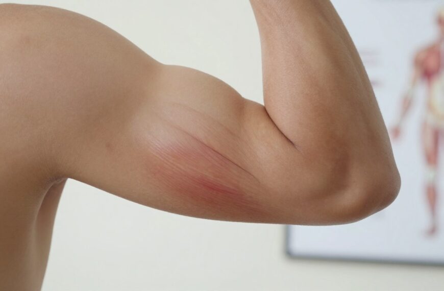 Zerwanie mięśnia dwugłowego ramienia – objawy, leczenie i co oznacza „pęknięty biceps”